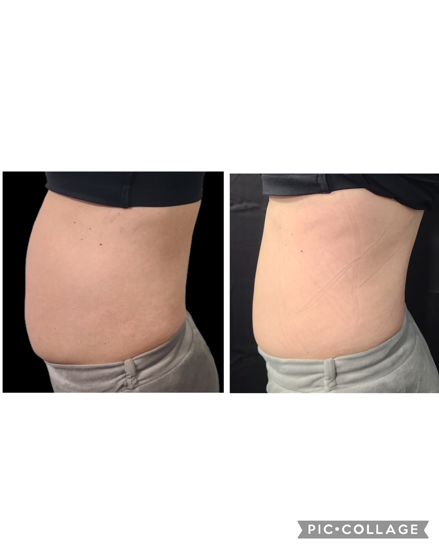Emsculpt NEO Results 7